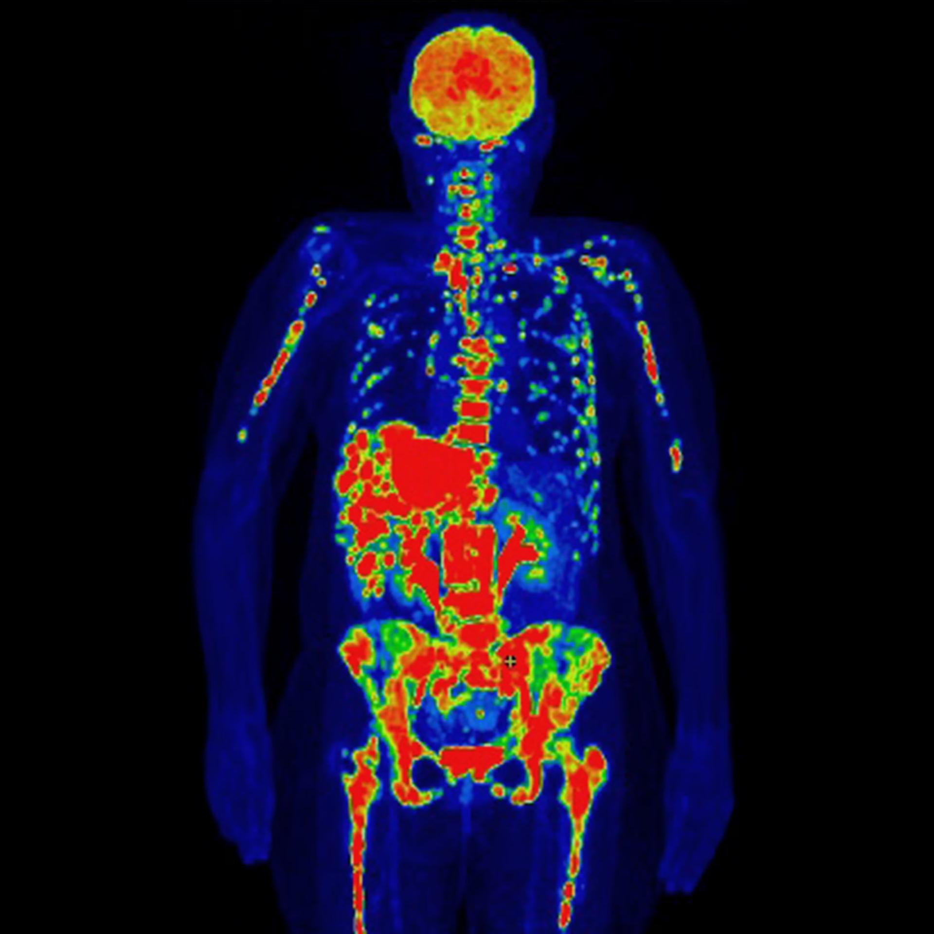Scansione PET di una paziente con cancro al seno che si è diffuso ai linfonodi, alle ossa e al fegato.